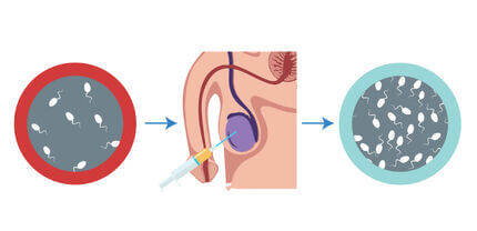 Intratesticular PRP injection