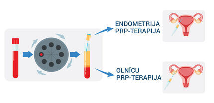 PRP‑behandling för kirurgisk rekonstruktion av livmoderslemhinnan och återställande av äggstockarnas funktion