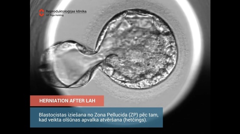 Herniation after LAH (Laser Assisted Hatching)_iVF Riga Embryolab