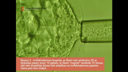 Trophectoderm biopsy-2 in the iVF Riga clinic embryolab