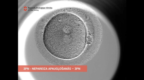 Incorrect fertilization of an embryo - 3PN