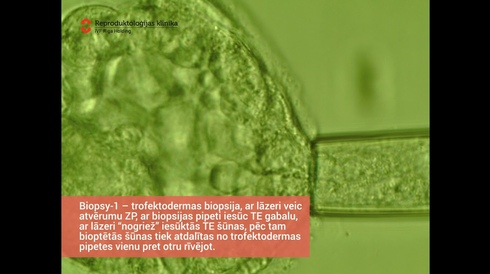 Trophectoderm biopsy-1 in the iVF Riga clinic embryolab